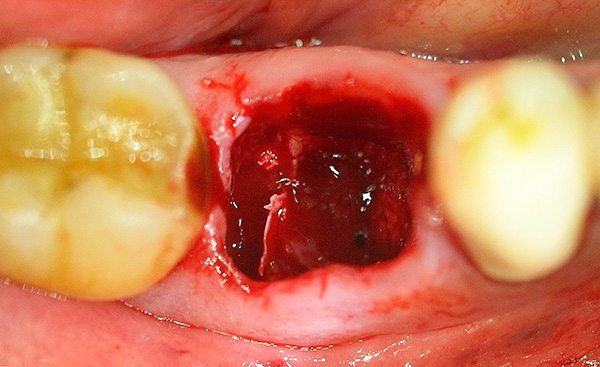 Si hubiera tejidos infectados en las raíces del diente, en el futuro esto podría contribuir a la inflamación del orificio (incluido el desarrollo de alveolitis).