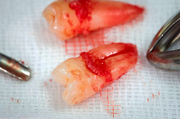 A menudo, el dentista-cirujano tiene que extraer los dientes sanos, como las muelas del juicio.