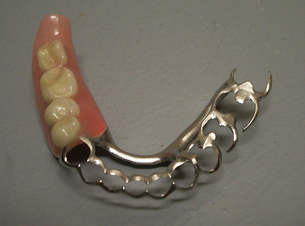En algunos casos, es posible evitar que los dientes móviles del paciente se retiren mediante la prótesis parcial debido al efecto de férula de la estructura.