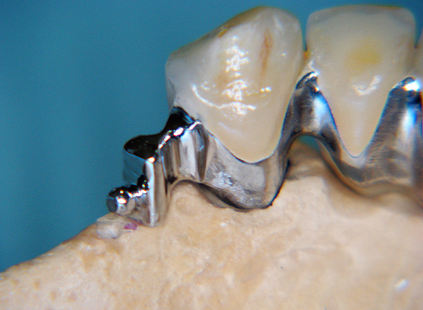 يتم إرفاق جزء من القفل الصغير بالتاج ، الذي يتم وضعه على الأسنان الداعمة.