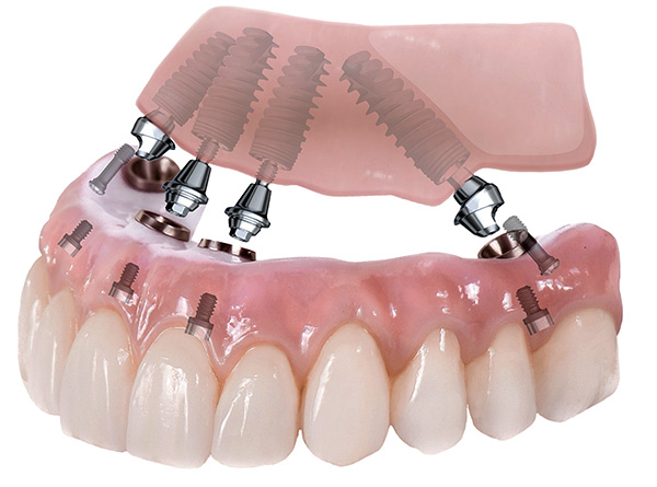 На снимката е представена схемата на зъбната протеза, използваща технологията All-on-4.