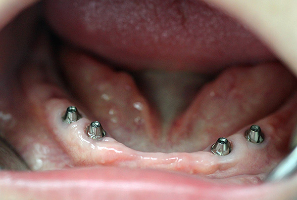 Se implantan 4 implantes en la mandíbula ...