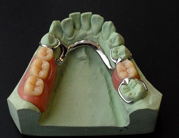 بشكل عام ، فإن تصنيع طقم الأسنان الجزئي هو إجراء معقد متعدد الخطوات ، والذي يستمر عادة من 2 إلى 4 أسابيع.