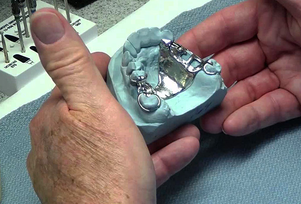 Adquisición de prótesis parcial sobre un modelo de yeso de la mandíbula.