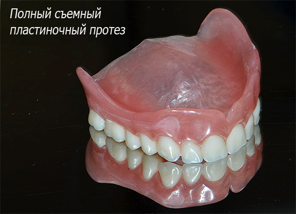 Снимката показва пълна сменяема ламинарна протеза - тя се държи в устната кухина поради всмукване към венците и небето.