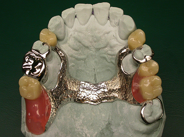 يتم تثبيت الطرف الاصطناعي في الفم أكثر موثوقية وأقوى من اللوحة.