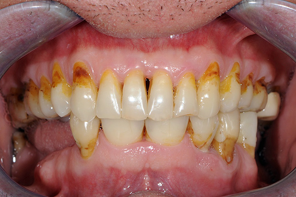 La posibilidad de una fijación confiable de la prótesis parcial está determinada en gran medida por la condición de la cavidad oral del paciente.