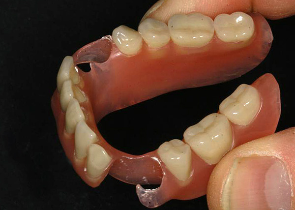 Con una gran cantidad de dientes faltantes en la boca, el uso de una prótesis de nylon estará lejos de ser la mejor opción para las prótesis ...