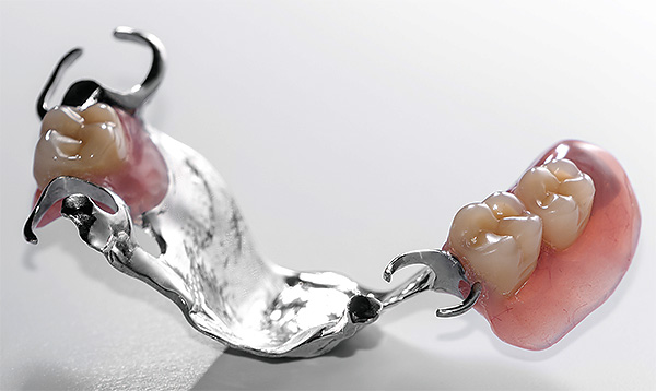 La variante más simple de la prótesis de cierre removible es una estructura que se sujeta a los dientes con ganchos de metal (cierres).