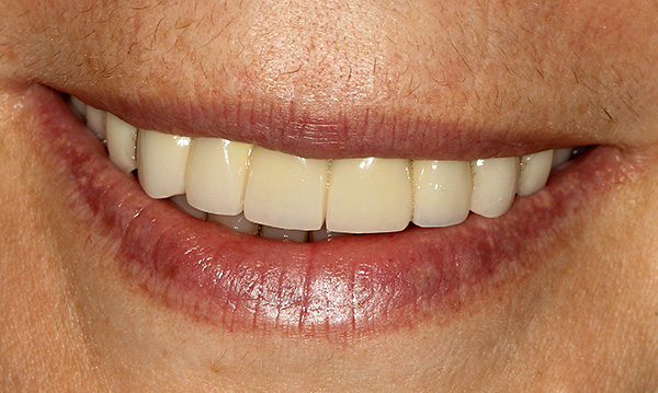 Las dentaduras removibles de alta calidad le permiten restaurar la función de masticación y la belleza de una sonrisa.