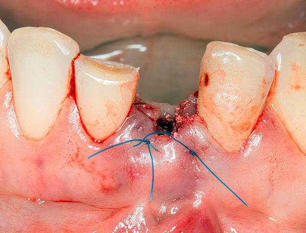 Las dentaduras inmediatas se utilizan para restaurar la estética casi inmediatamente después de la extracción dental.