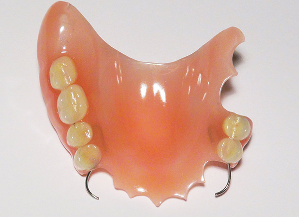 Dentadura acrílica parcial (en la mandíbula superior)