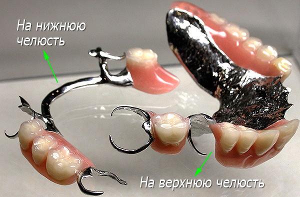 Prótesis de broche en la mandíbula superior e inferior con cierre en los broches.