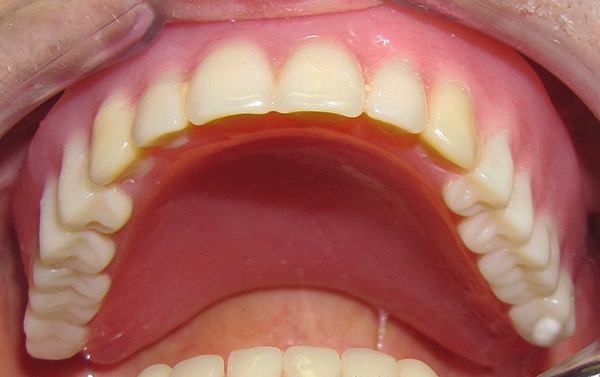 Y así es como se ve la mandíbula superior después de instalar una dentadura laminar removible completa en ella.