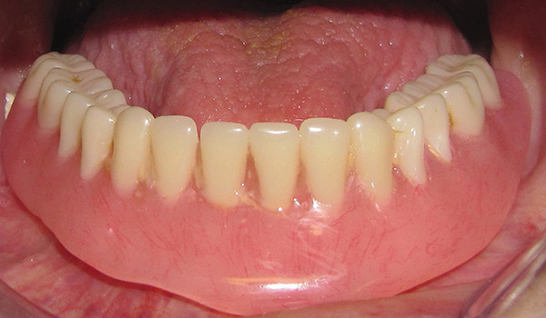 El resultado de las prótesis utilizando una dentadura completa ...
