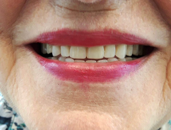 La foto muestra el resultado de las prótesis con el uso de dentaduras completas (tanto en la mandíbula superior como en la inferior).