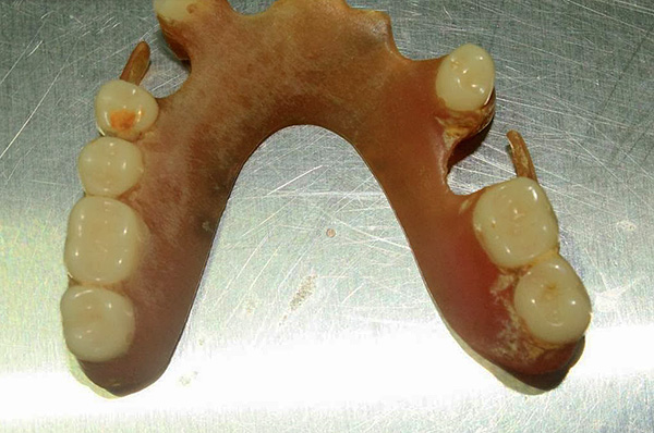 La placa bacteriana se forma en cualquier dentadura, por lo que es importante limpiarla regularmente.