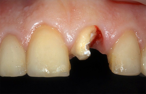 Caso clínico: el diente frontal está roto debido a una lesión mecánica.