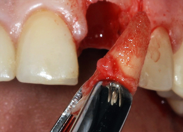 Para llevar a cabo la implantación inmediata, la raíz del diente debe eliminarse con la mayor precisión posible, sin dañar las paredes óseas del orificio.