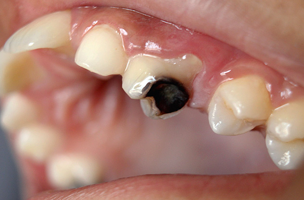 El costo de tratar un diente destruido por caries se ve afectado de inmediato por muchos factores, que consideraremos y ...