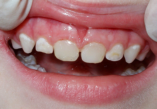 Un exemple de carie initiale sur les dents du bébé.