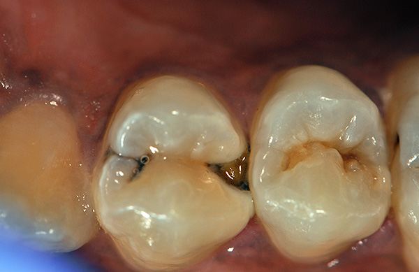 Le coût d'un joint placé sur une dent après sa préparation peut varier de plusieurs fois.