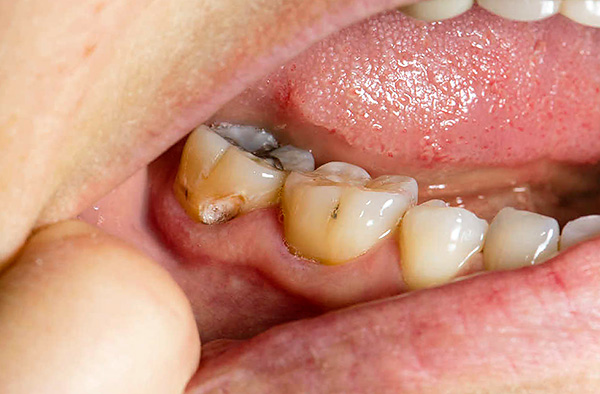 Si este diente no se trata a tiempo, el proceso de caries en el área cervical solo progresará.