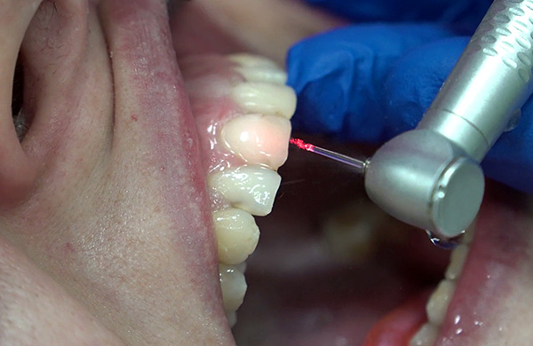 La fotografía muestra la preparación del diente anterior utilizando un láser dental.