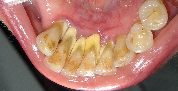 La fotografía muestra un ejemplo típico de la condición de los dientes con un nivel insatisfactorio de higiene oral.