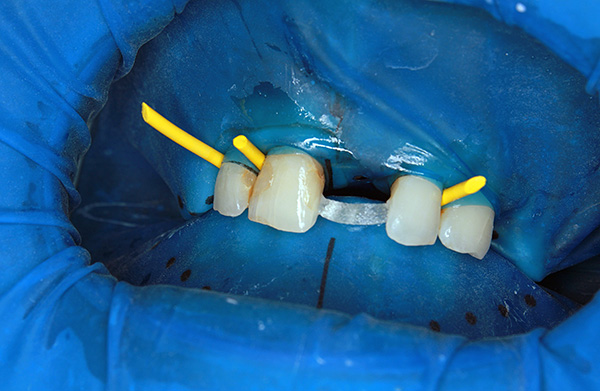 La cinta de fibra de vidrio entre los dientes del pilar es claramente visible: se formará una futura prótesis compuesta.