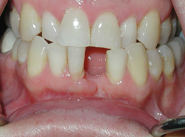 La situación antes del tratamiento - no hay un diente frontal desde la parte inferior.