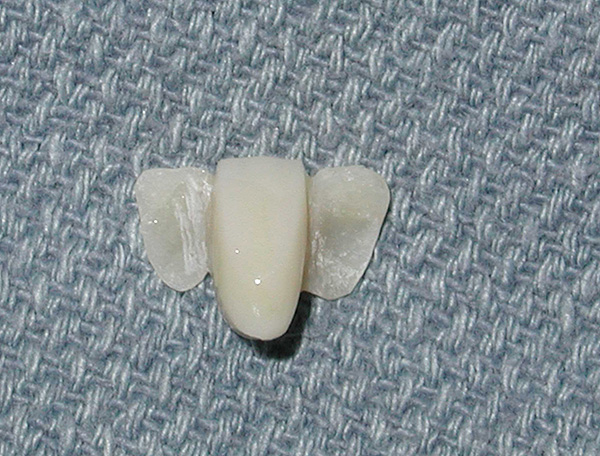 La prótesis tiene placas especiales en el lado que se pegarán a los dientes de soporte.