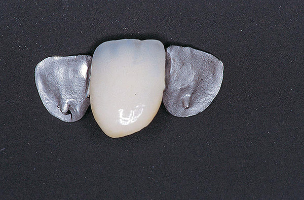 Debe tenerse en cuenta que dicho diseño solo debe utilizarse para la eliminación temporal de un defecto en la dentición.