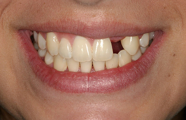 La pérdida de un solo diente sin prótesis oportunas puede tener un impacto muy negativo en la condición de todo el sistema dental.