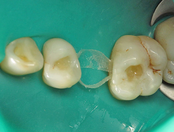 La base de fibra de vidrio de la futura prótesis se estira entre los dientes.