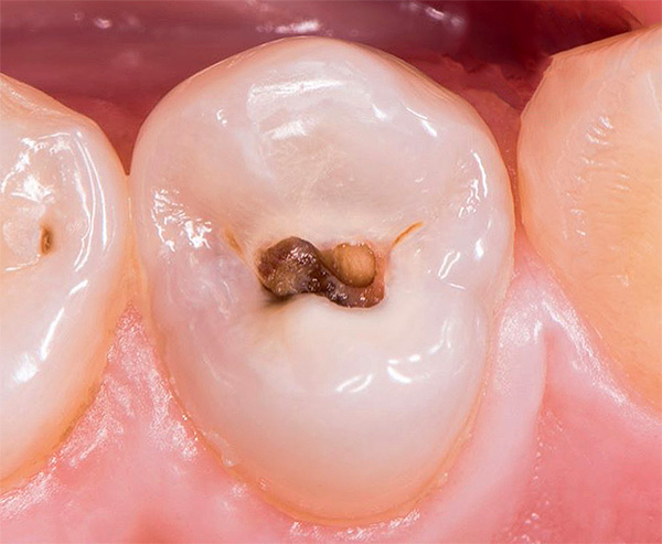 Con una caries promedio, el proceso de destrucción afecta no solo al esmalte dental, sino también a la dentina debajo de él ...