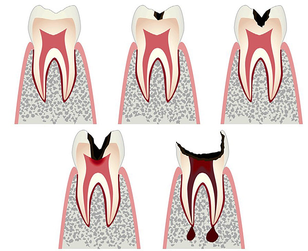 Les étapes du développement du processus carieux avec le passage aux complications - pulpite et parodontite.