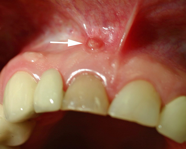 À travers la fistule située sur la gencive au-dessus de la dent, le pus est évacué dans la cavité buccale.
