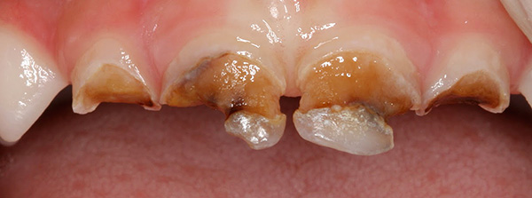 La falta de un tratamiento oportuno de la caries de los dientes de leche en un niño puede dañar seriamente la salud del bebé en general.