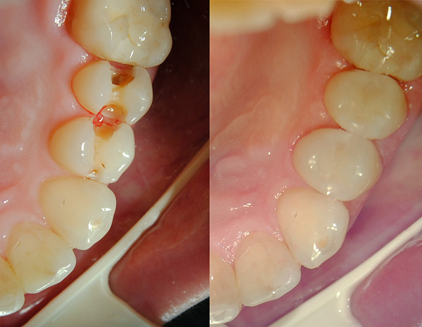 El material del relleno es prácticamente indistinguible de los tejidos dentales naturales.