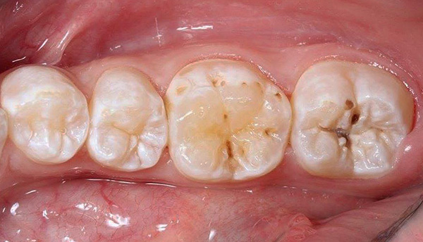Les fissures des dents de mastication sont souvent atteintes de caries, en raison de l'accumulation de débris alimentaires.