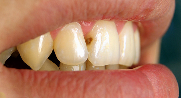 Carie moyenne sur la dent antérieure