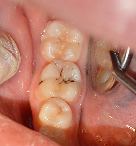 Processus carieux dans la fissure de la dent inférieure.