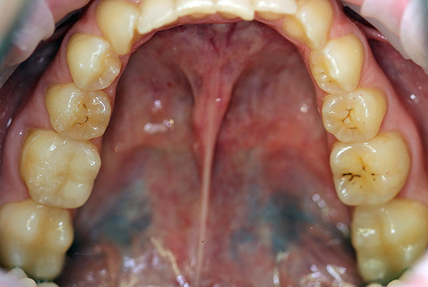 Le taux de carie dentaire dû au processus carieux est différent pour toutes les personnes et dépend de nombreux facteurs, notamment des caractéristiques individuelles de l'organisme.