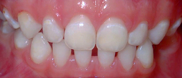 Les taches blanches sont des zones de déminéralisation de l'émail des dents.