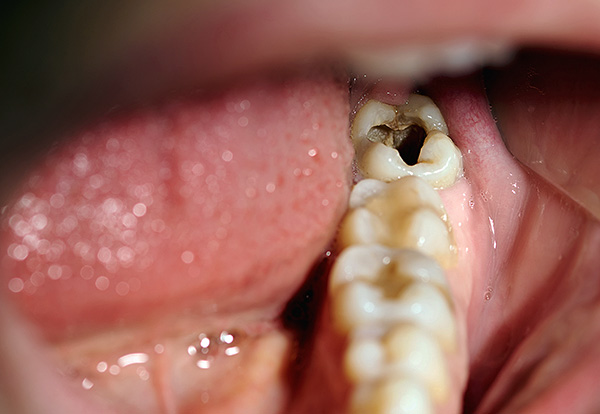 Caries profundas del diente inferior de masticación.