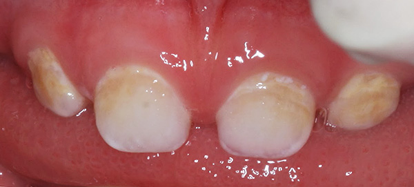 Caries de dientes de leche en la etapa de mancha blanca (calcárea).