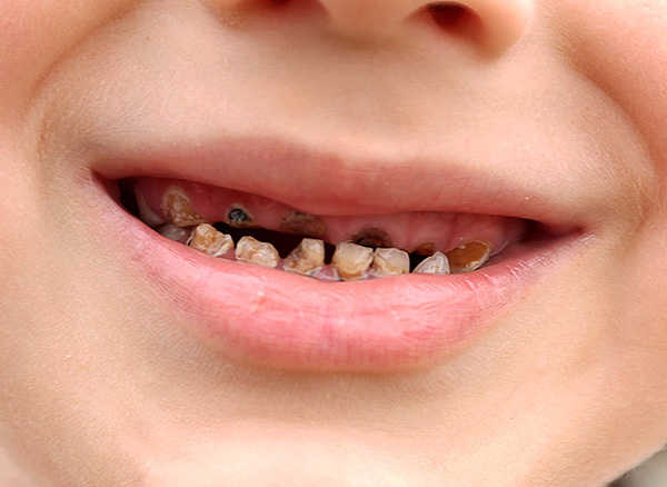 Si no monitorea la condición de los dientes del bebé, él puede formar complejos psicológicos, que a veces persisten durante muchos años.