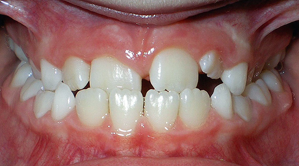 Se puede producir una maloclusión, incluida la pérdida prematura de los dientes de leche, que se destruye por la caries.
