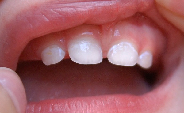 La desmineralización del esmalte dental en las etapas iniciales se manifiesta en tales manchas blancas.